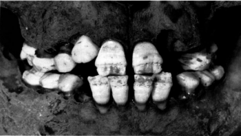 Figure 2: DEH on the enamel of the incisors observed in a non-adult from the post-medieval London Spitalfields population (Molleson and Cox 1993, 62).